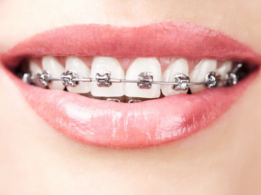 Lady shows her teeth with traditional braces