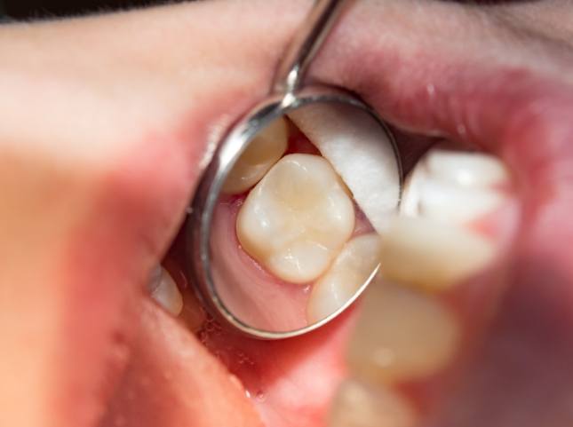 Close up of dental mirror inside of mouth reflecting a tooth
