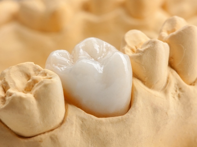 Dental crown covering a tooth in a model of the mouth