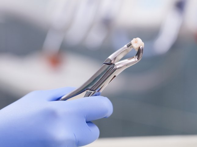 Dental forceps holding an extracted tooth