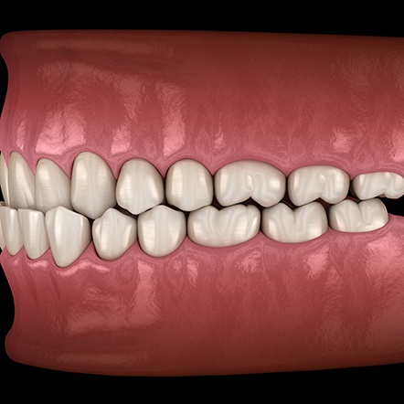 Illustration of a crossbite