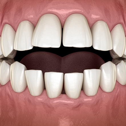 Illustration of a crossbite
