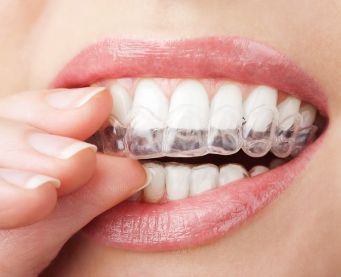 Close up of person placing Invisalign aligner over their teeth