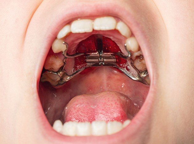 Child with a palatal expander